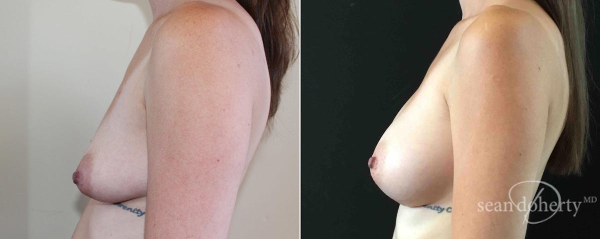 Breast Augmentation Before & After Gallery - Patient 112266 - Image 3