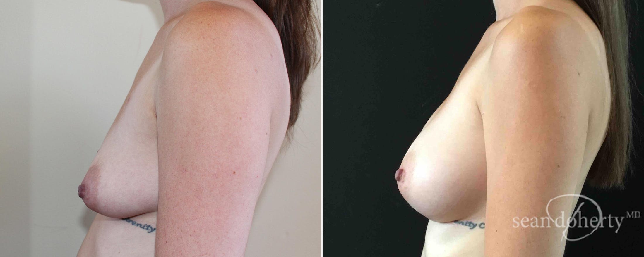 Breast Augmentation Before & After Gallery - Patient 112266 - Image 3