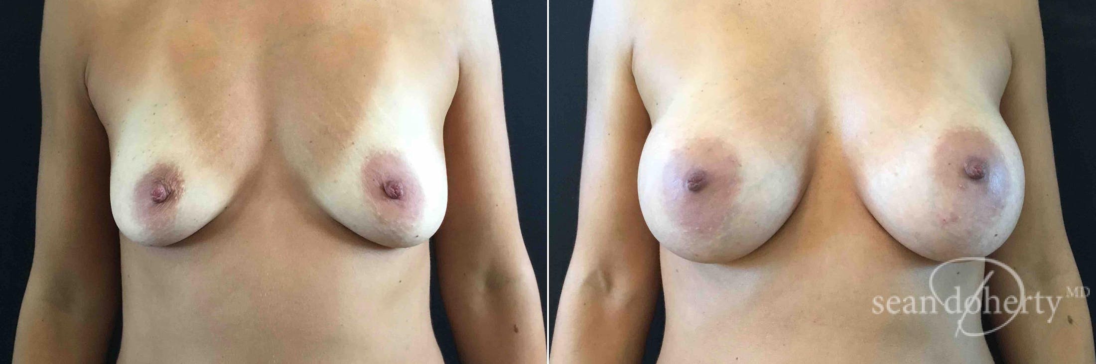 Breast Augmentation Before & After Gallery - Patient 963666 - Image 1