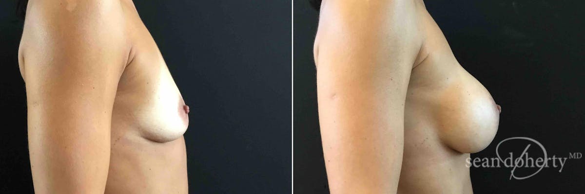 Breast Augmentation Before & After Gallery - Patient 963666 - Image 2