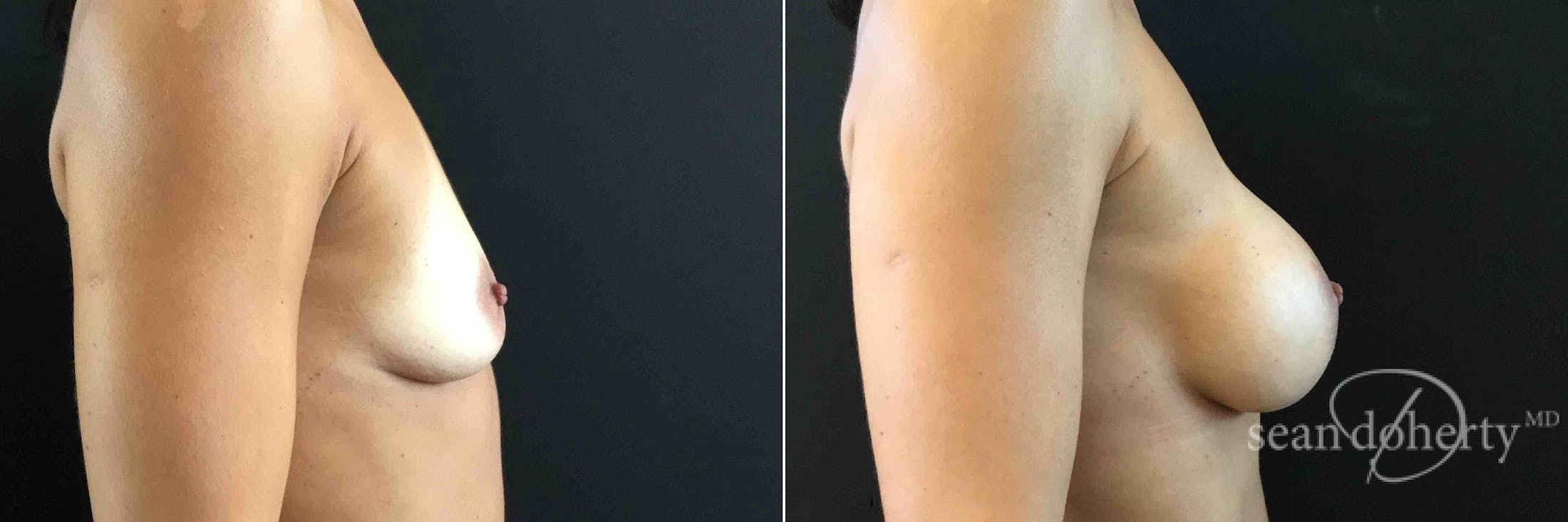 Breast Augmentation Before & After Gallery - Patient 963666 - Image 2
