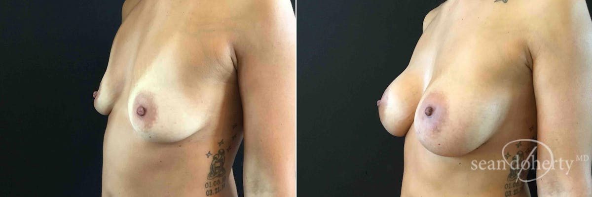 Breast Augmentation Before & After Gallery - Patient 963666 - Image 3