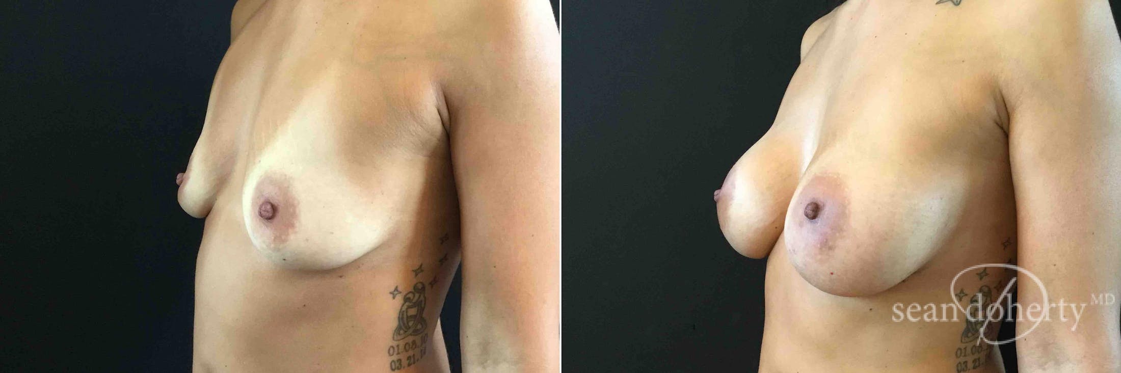 Breast Augmentation Before & After Gallery - Patient 963666 - Image 3