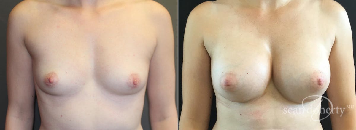 Breast Augmentation  Before & After Gallery - Patient 191484 - Image 1