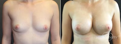 Breast Augmentation Before & After Gallery - Patient 191484 - Image 1
