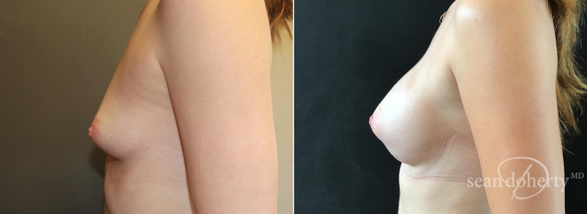 Breast Augmentation  Before & After Gallery - Patient 191484 - Image 3