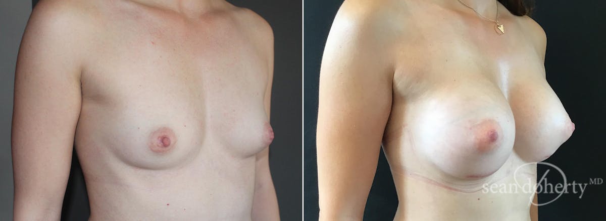 Breast Augmentation  Before & After Gallery - Patient 191484 - Image 2