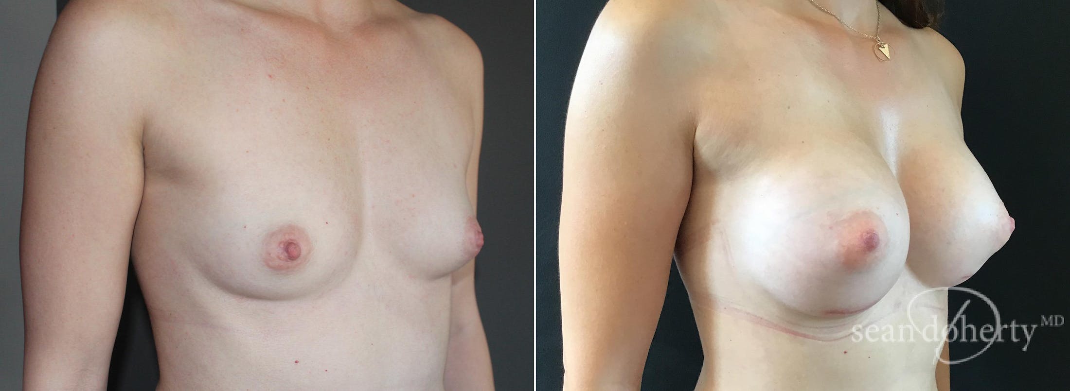 Breast Augmentation Before & After Gallery - Patient 191484 - Image 2