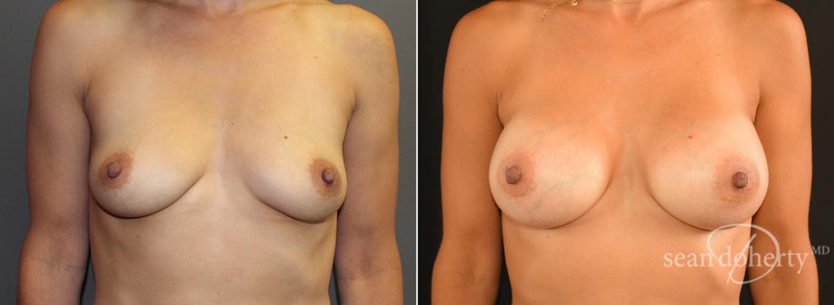 Breast Augmentation  Before & After Gallery - Patient 231048 - Image 1