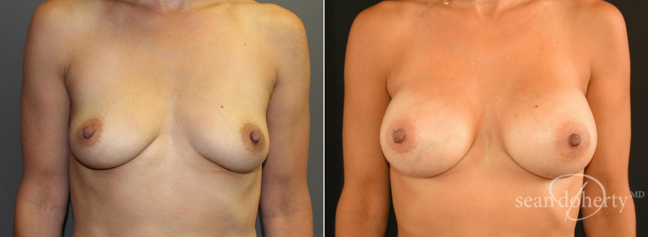 Breast Augmentation Before & After Gallery - Patient 231048 - Image 1