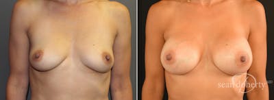 Breast Augmentation Before & After Gallery - Patient 231048 - Image 1