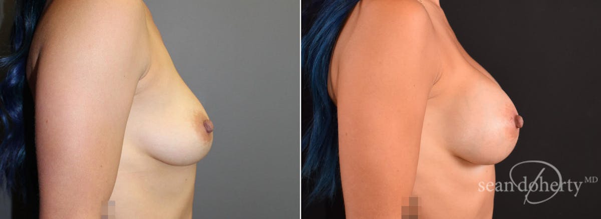 Breast Augmentation  Before & After Gallery - Patient 231048 - Image 3
