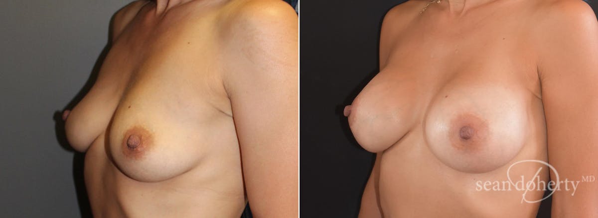 Breast Augmentation  Before & After Gallery - Patient 231048 - Image 2