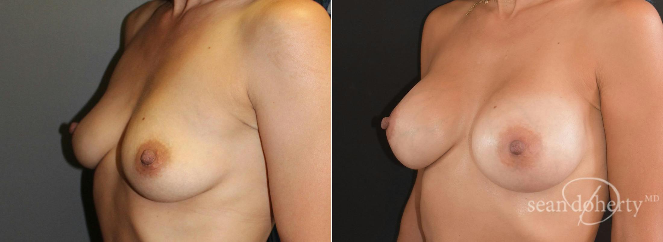 Breast Augmentation Before & After Gallery - Patient 231048 - Image 2