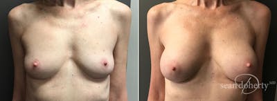Breast Augmentation Before & After Gallery - Patient 269702 - Image 1