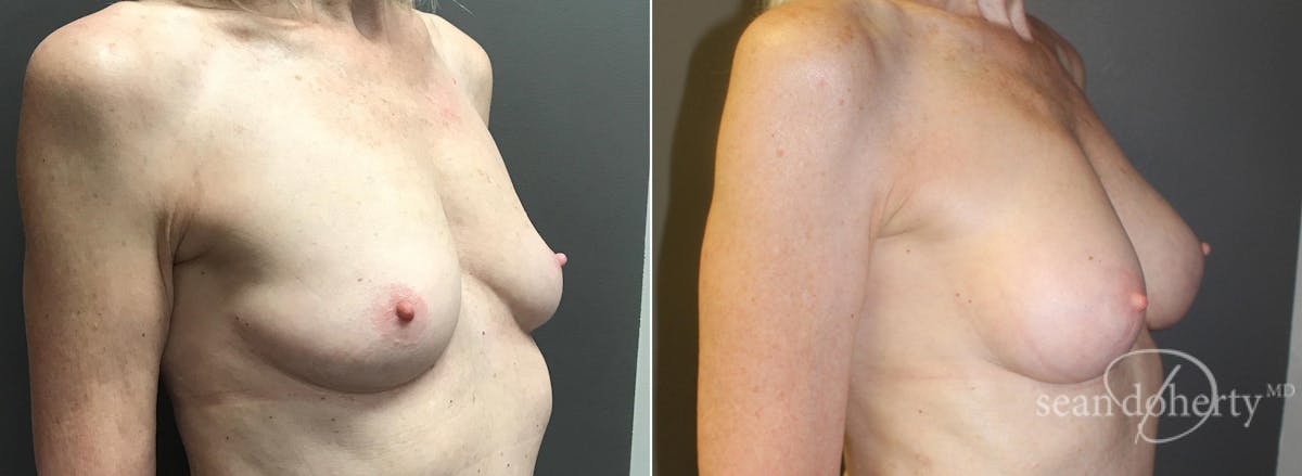 Breast Augmentation Before & After Gallery - Patient 269702 - Image 2