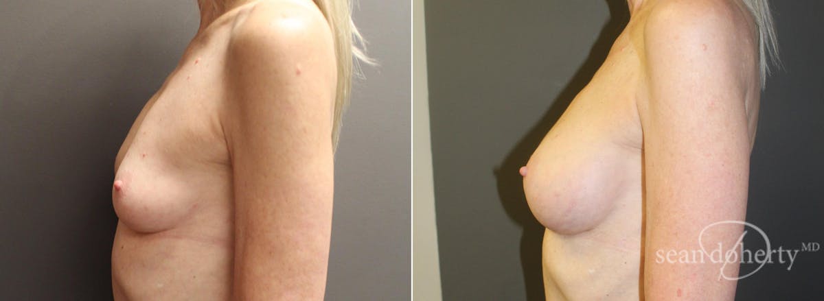 Breast Augmentation Before & After Gallery - Patient 269702 - Image 3