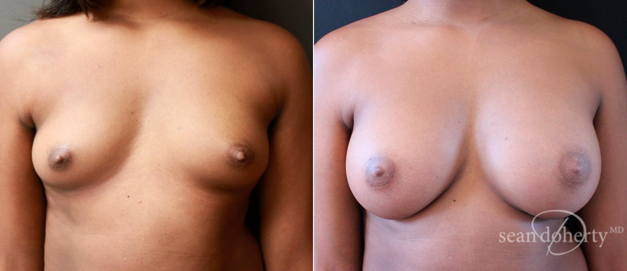 Breast Augmentation Before & After Gallery - Patient 470394 - Image 1