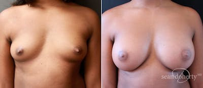 Breast Augmentation Before & After Gallery - Patient 470394 - Image 1