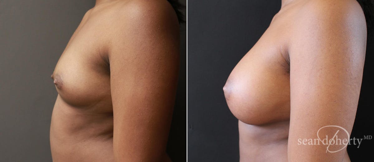 Breast Augmentation Before & After Gallery - Patient 470394 - Image 3