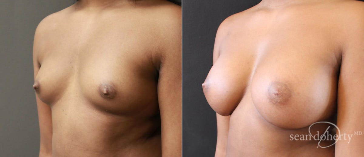 Breast Augmentation Before & After Gallery - Patient 470394 - Image 2