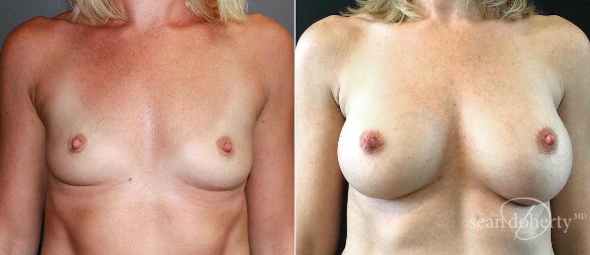 Breast Augmentation Before & After Gallery - Patient 293328 - Image 1