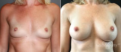 Breast Augmentation Before & After Gallery - Patient 293328 - Image 1