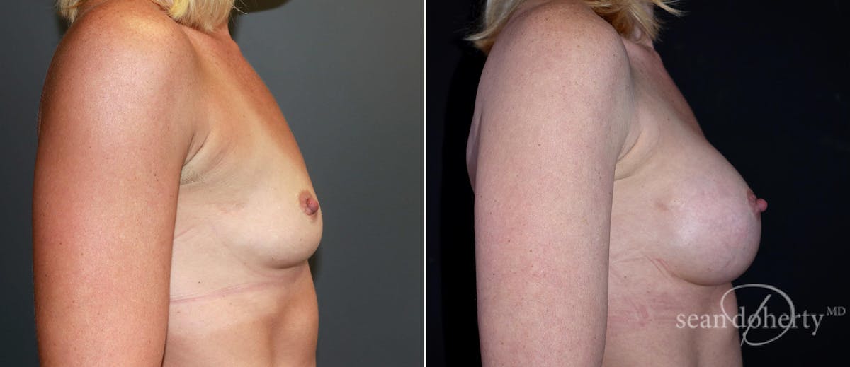 Breast Augmentation Before & After Gallery - Patient 293328 - Image 3