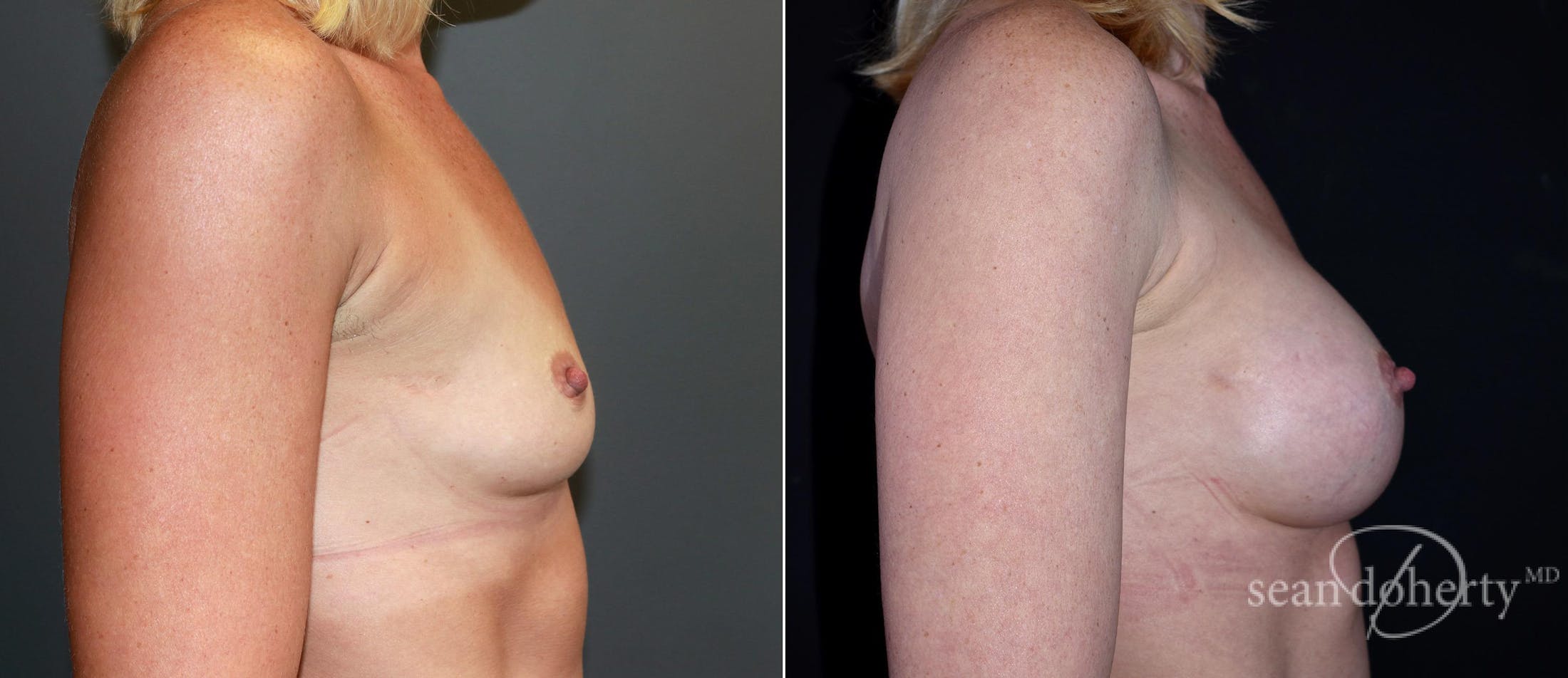 Breast Augmentation Before & After Gallery - Patient 293328 - Image 3
