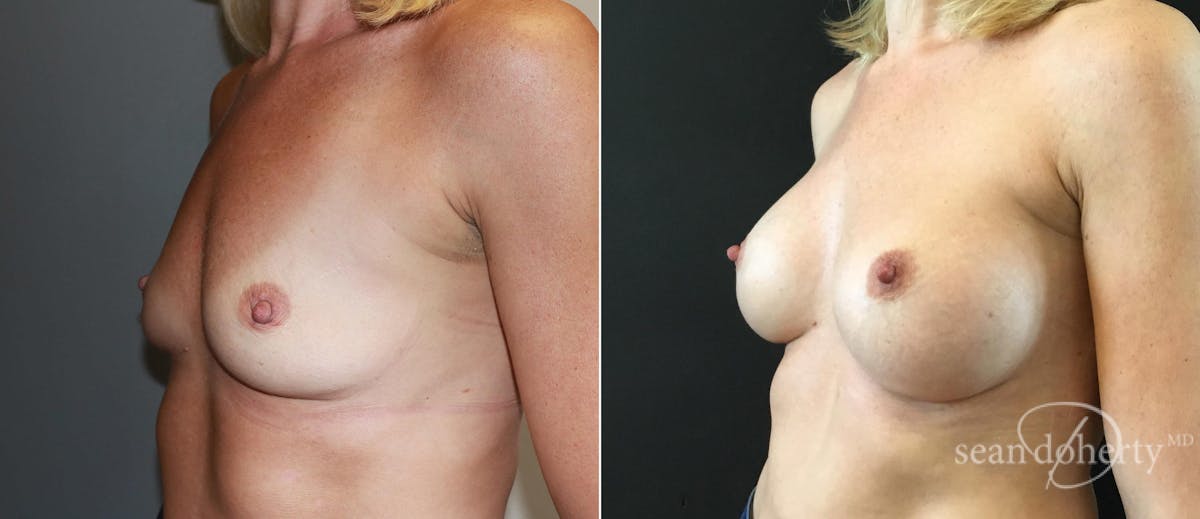 Breast Augmentation Before & After Gallery - Patient 293328 - Image 2