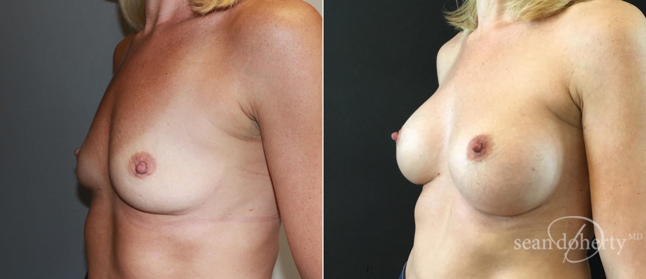 Breast Augmentation Before & After Gallery - Patient 293328 - Image 2