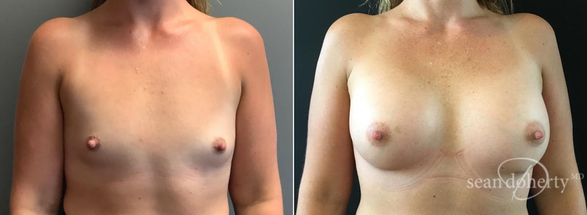 Breast Augmentation  Before & After Gallery - Patient 124853 - Image 1