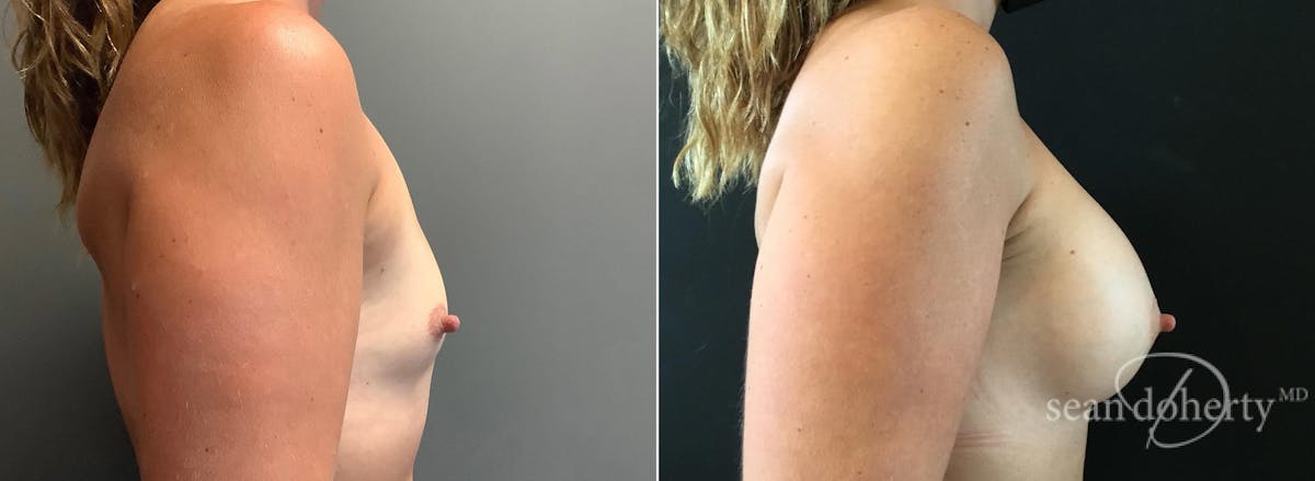 Breast Augmentation  Before & After Gallery - Patient 124853 - Image 3