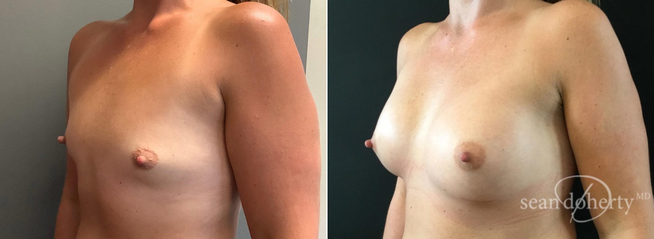 Breast Augmentation Before & After Gallery - Patient 124853 - Image 2