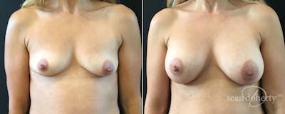 Breast Augmentation Before & After Gallery - Patient 201471 - Image 1