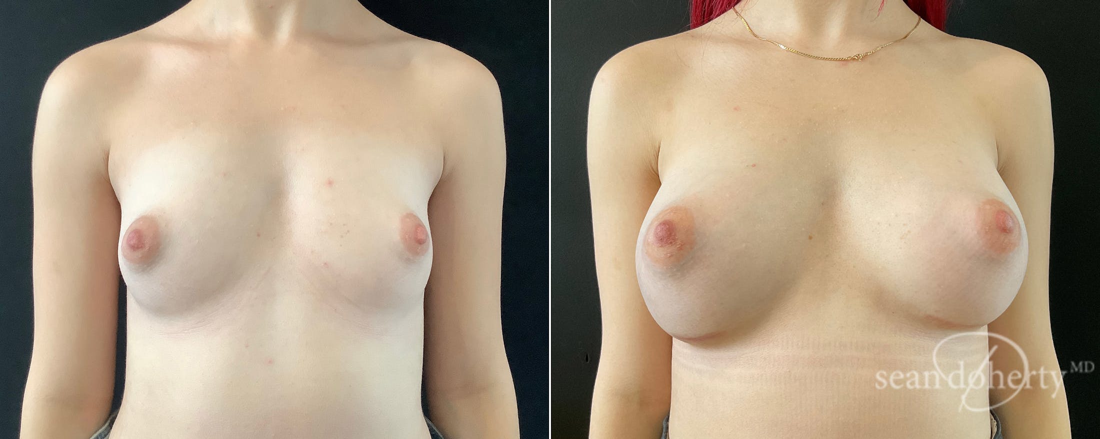 Breast Augmentation Before & After Gallery - Patient 415056 - Image 1