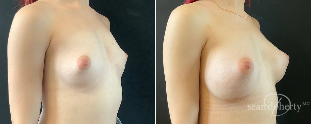 Breast Augmentation Before & After Gallery - Patient 415056 - Image 2