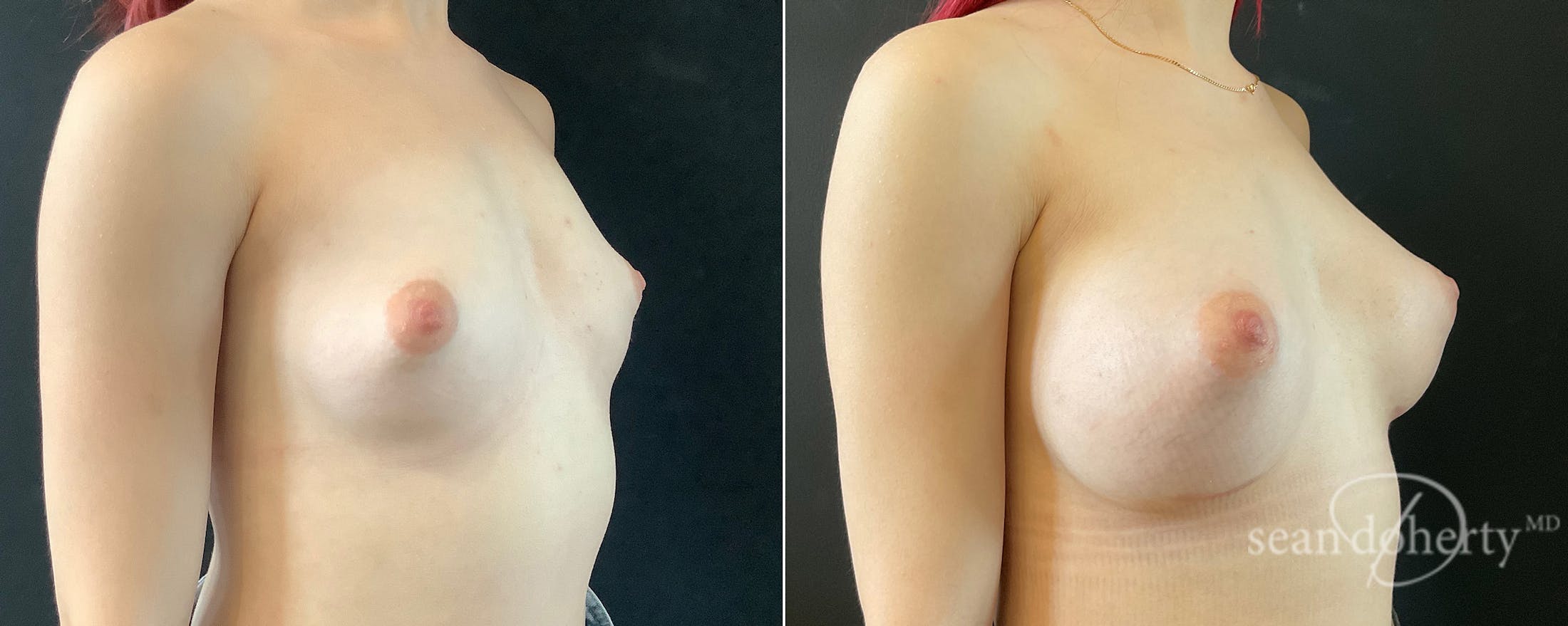 Breast Augmentation Before & After Gallery - Patient 415056 - Image 2