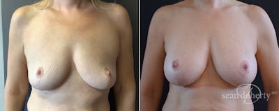 Breast Augmentation Before & After Gallery - Patient 236789 - Image 1