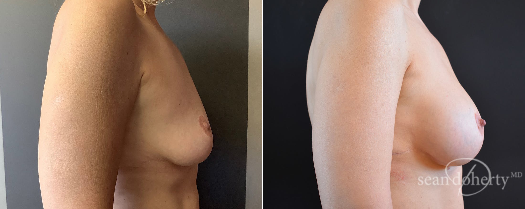 Breast Augmentation Before & After Gallery - Patient 236789 - Image 3