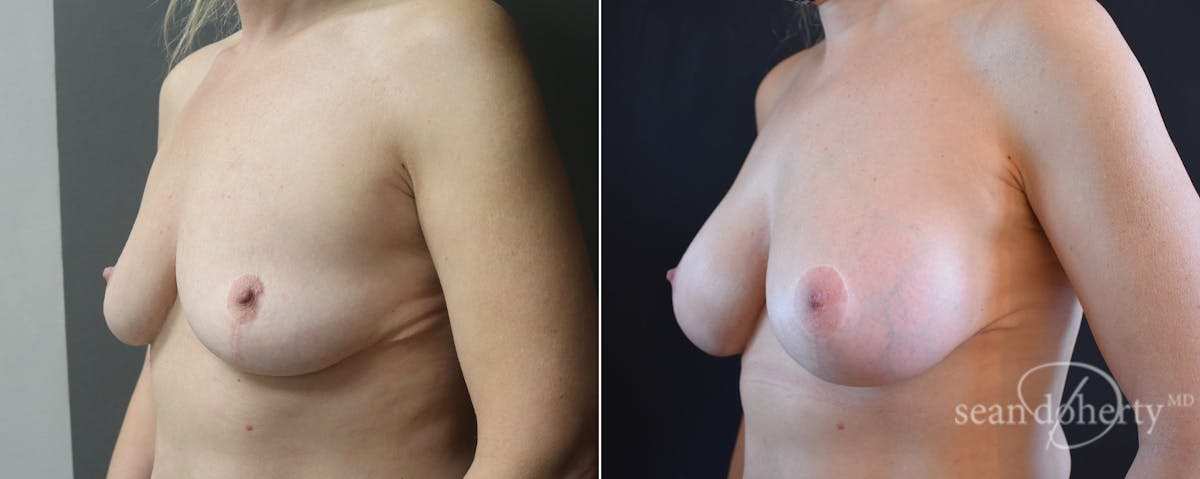 Breast Augmentation Before & After Gallery - Patient 236789 - Image 2