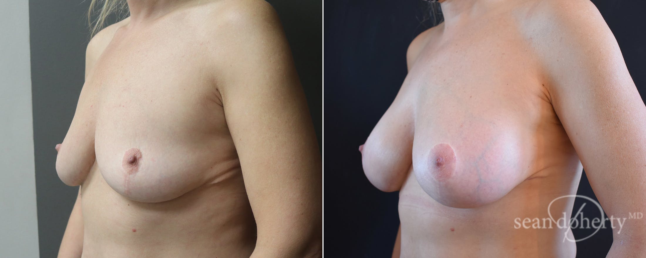 Breast Augmentation Before & After Gallery - Patient 236789 - Image 2