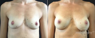Breast Augmentation Before & After Gallery - Patient 371754 - Image 1