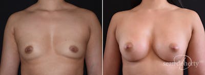 Breast Augmentation Before & After Gallery - Patient 248801 - Image 1