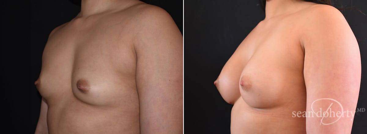 Breast Augmentation Before & After Gallery - Patient 248801 - Image 2