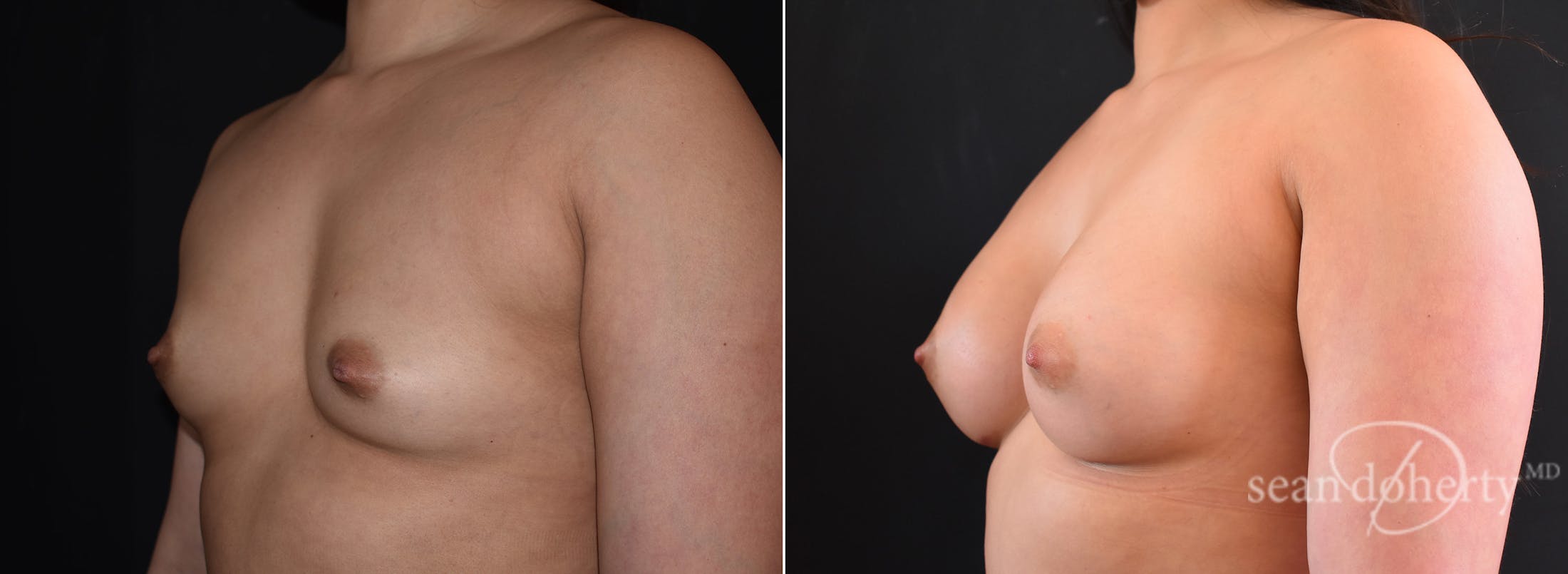 Breast Augmentation Before & After Gallery - Patient 248801 - Image 2