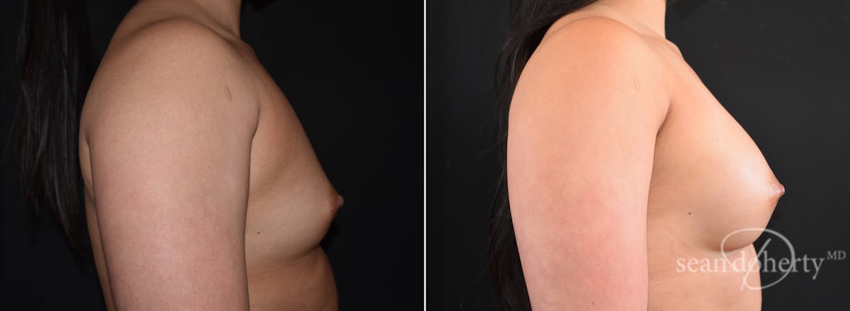 Breast Augmentation Before & After Gallery - Patient 248801 - Image 3