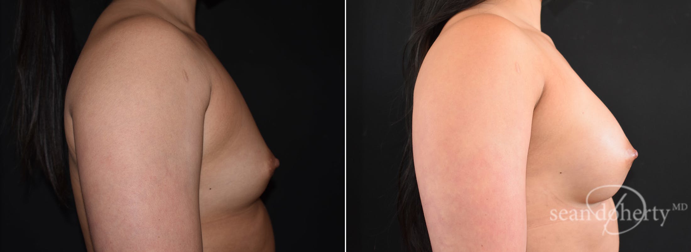 Breast Augmentation Before & After Gallery - Patient 248801 - Image 3