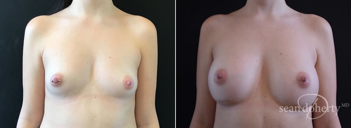 Breast Augmentation  Before & After Gallery - Patient 244166 - Image 1