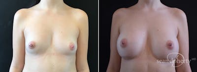 Breast Augmentation Before & After Gallery - Patient 244166 - Image 1